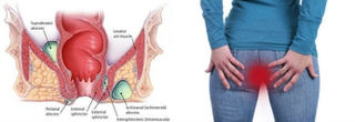 Illustration for article titled Obat Fistula Ani Tradisional